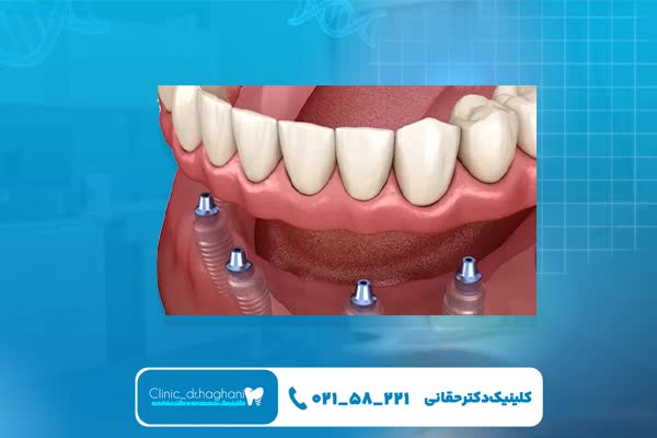 ایمپلنت دندان به صورت یک روزه