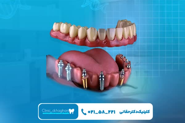 ایمپلنت دندان قسطی