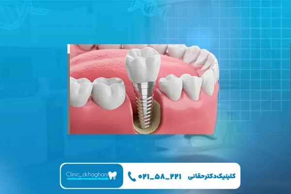 مزیت ایمپلنت دندان بدون عارضه