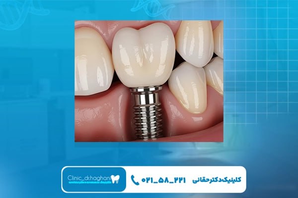ایمپلنت دندان با حداقل درد در فضای آرام کلینیک دندانپزشکی حقانی در تهران