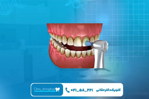 دلایل تغییر رنگ دندان ها در طول زمان