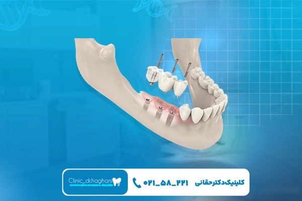 بررسی‌های قبل از ایمپلنت دندان 