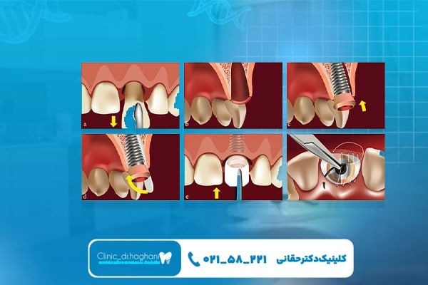 مراحل انجام ایمپلنت دندان با برنامه‌ریزی شامل چیست؟