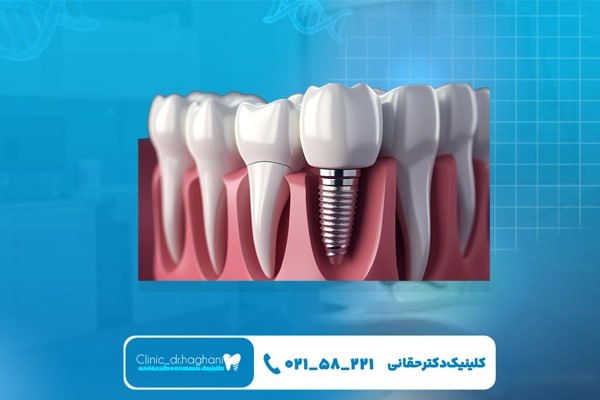 مراحل انجام ایمپلنت دندان با برنامه درمانی شامل چیست؟