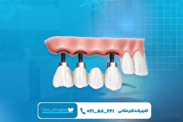 ایمپلنت دندان با استاندارد جهانی در بهترین کلینیک‌های دندانپزشکی