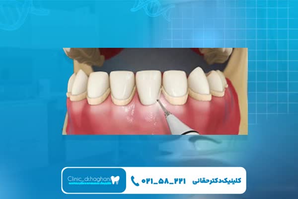 روش جرمگیری دندان روش جرمگیری دندان