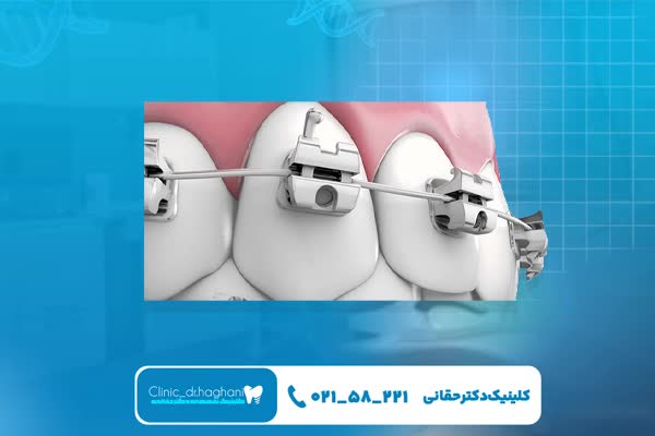 ارتودنسی دیجیتال دندان در تهران