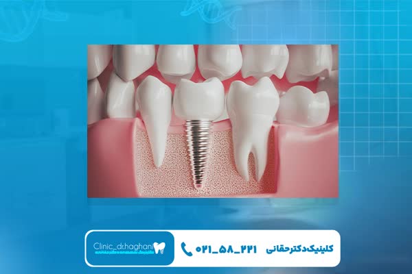 ایمپلنت دندان تخصصی شمال تهران