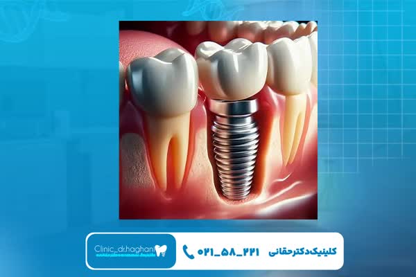 مراحل ایمپلنت دندان