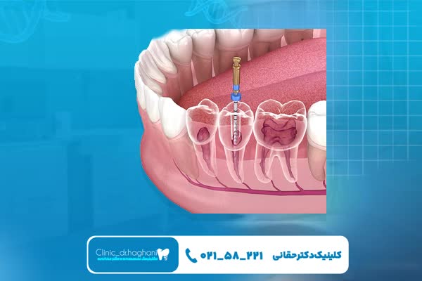 آیا عصب کشی برای همه دندانها ممکن است؟ آیا عصب کشی برای همه دندانها ممکن است؟