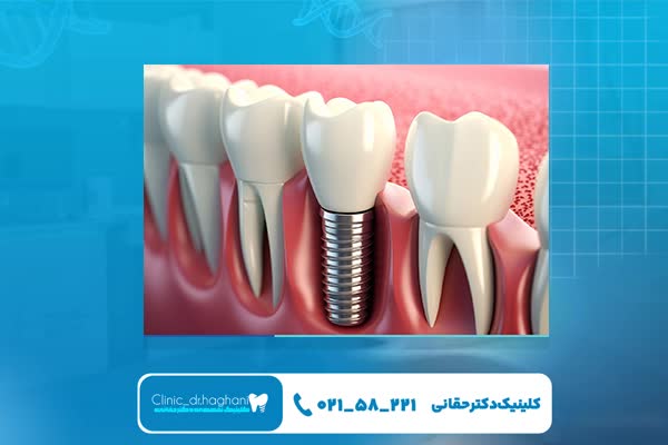 چگونه نتیجه ایمپلنت قطعی می‌شود؟