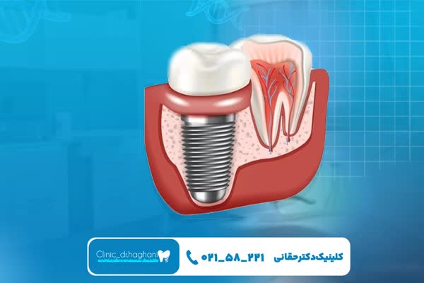 کاندیدای مناسب برای ایمپلنت یک روزه
