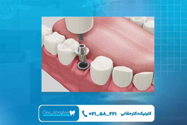 روش ایمپلنت‌ دندان
