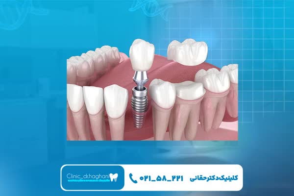 ایمپلنت دندان بدون عارضه