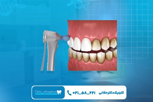  شیوه‌های نوین دندانپزشکی در کلینیک دندانپزشکی دکتر حقانی برای سفید کردن دندان