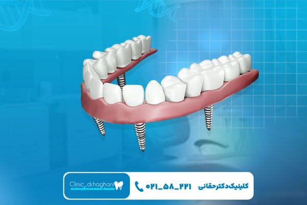 چرا کلینیک دندانپزشکی دکتر حقانی انتخابی مطمئن برای کاشت ایمپلنت است؟