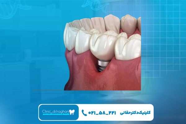 ایمپلنت دندان با مشاوره تخصصی در جردن