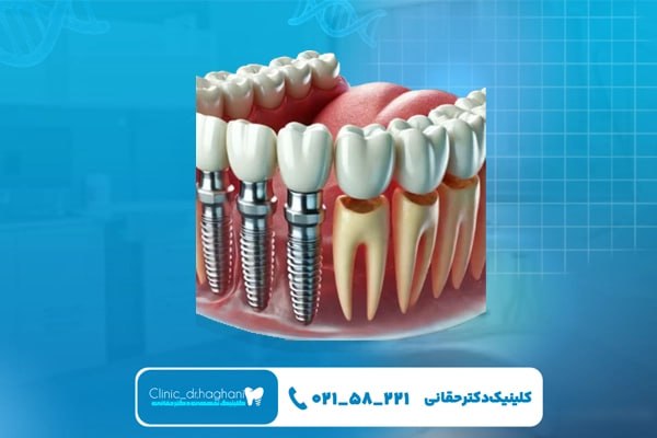 ایمپلنت دندان با برنامه درمانی