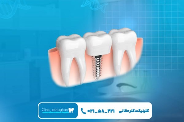 بهترین برند ایمپلنت دندان با استاندارد جهانی