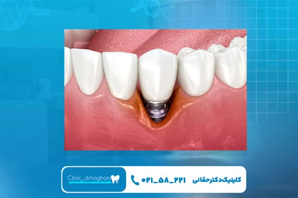 خدمات دندانپزشکی ایمپلنت دیجیتال