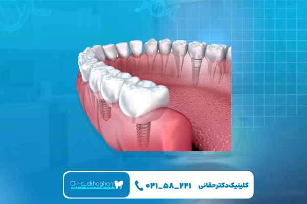 مشخصات کلینیک ایمپلنت‌ دندان تخصصی