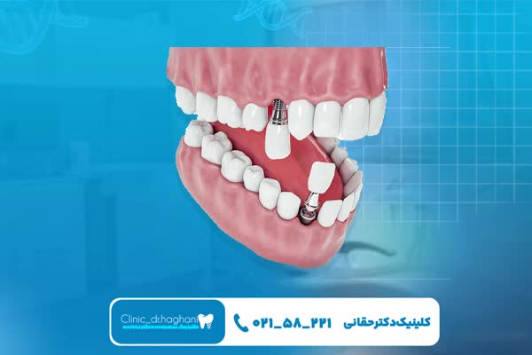 ایمپلنت دندان با طراحی دیجیتال