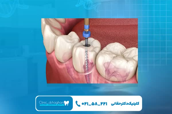 عصب کشی بدون درد عصب کشی بدون درد