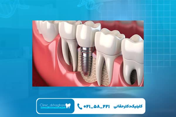 انواع ایمپلنت دندان