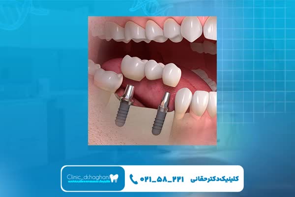 ایمپلنت دندان یک روزه