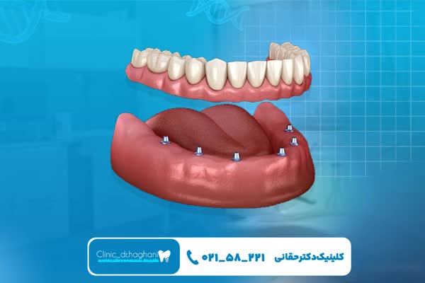 ایمپلنت دندان بدون درد